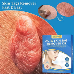 Skin Tag Remover Kit 2 In 1 For Micro To Large (2 Mm - 8 Mm  1 Set)